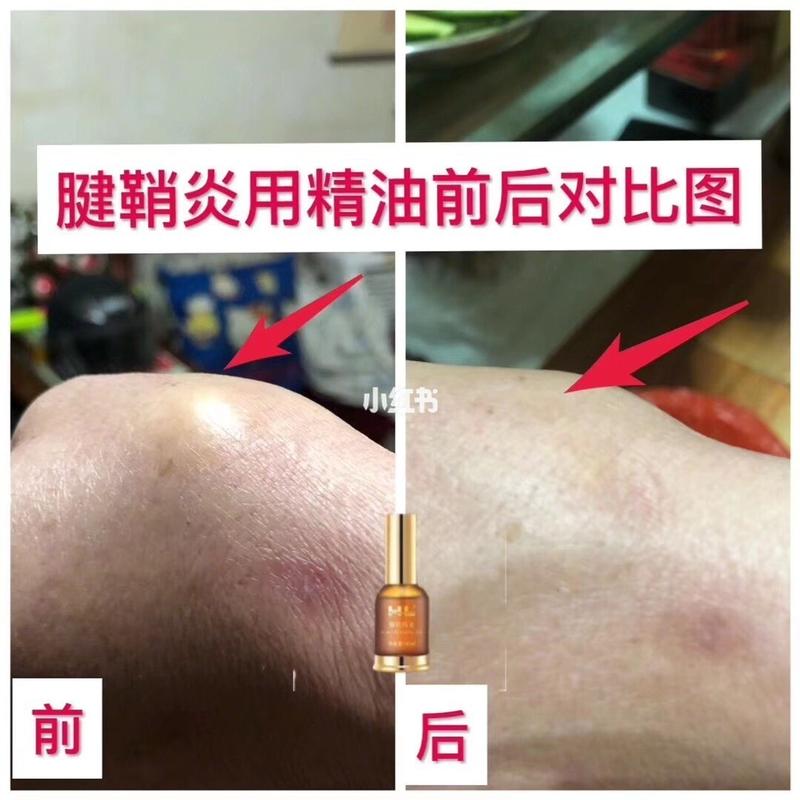 顾客腱鞘炎用精油前后对比图 好产品用效果说话